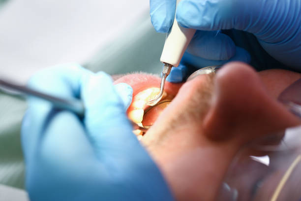 Best Dental Abscess Treatment in Hercules, CA